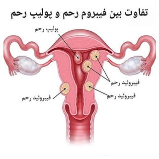 پولیپ رحم - دکتر ثناگو