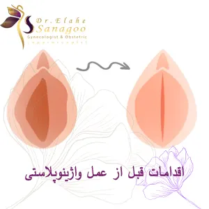 اقدامات قبل از عمل واژینوپلاستی