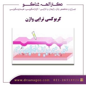 کربوکسی تراپی واژن - دکتر ثناگو
