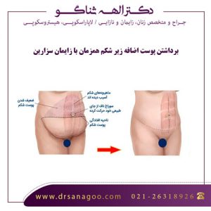 برداشتن پوست اضافه زیر شکم همزمان با زایمان سزارین