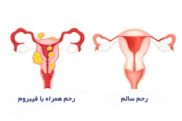 درمان فیبروم رحم در تهران - دکتر ثناگو