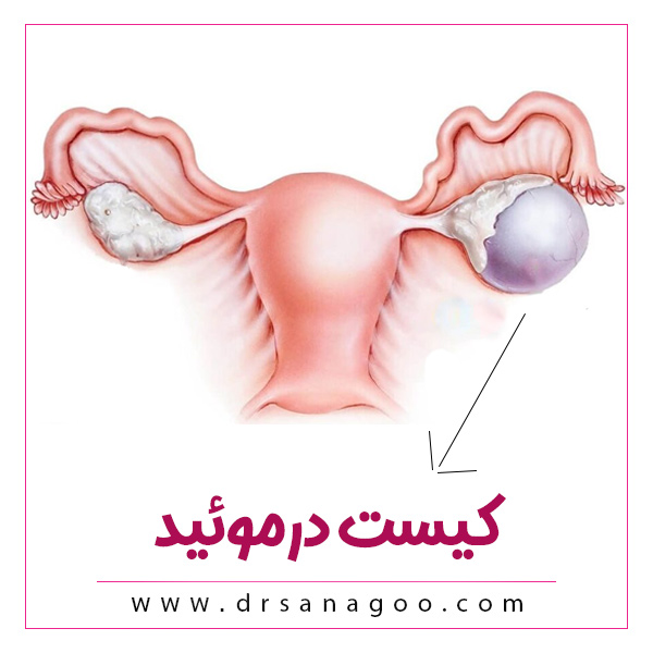 کیست درموئید را بشناسید!