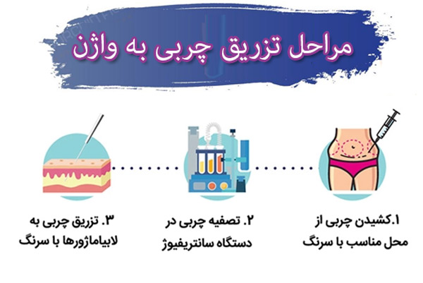 تزریق چربی به واژن در تهران - دکتر ثناگو
