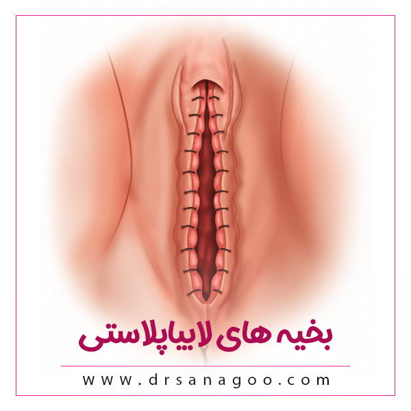 بخیه های لابیاپلاستی و نحوه مراقبت از آن