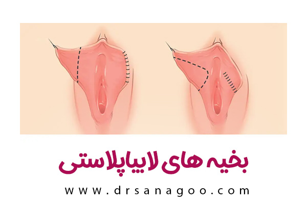 بخیه های لابیاپلاستی + دکتر الهه ثناگو