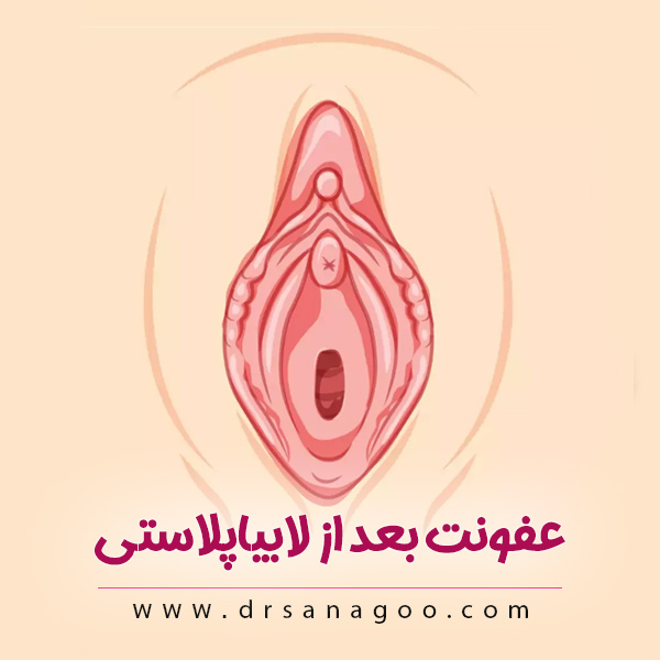 با عفونت بعد از لابیاپلاستی چه باید کرد؟