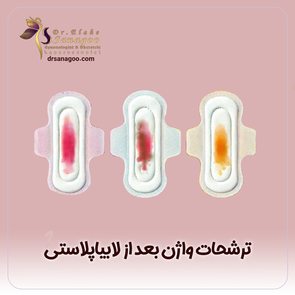 ترشحات واژن بعد از لابیاپلاستی + دکتر الهه ثناگو