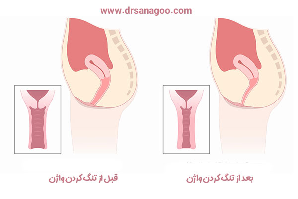 عمل تنگ کردن واژن در تهران + دکتر الهه ثناگو