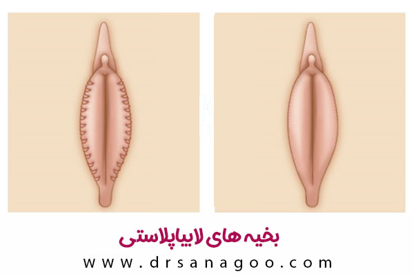 بخیه های لابیاپلاستی + دکتر الهه ثناگو