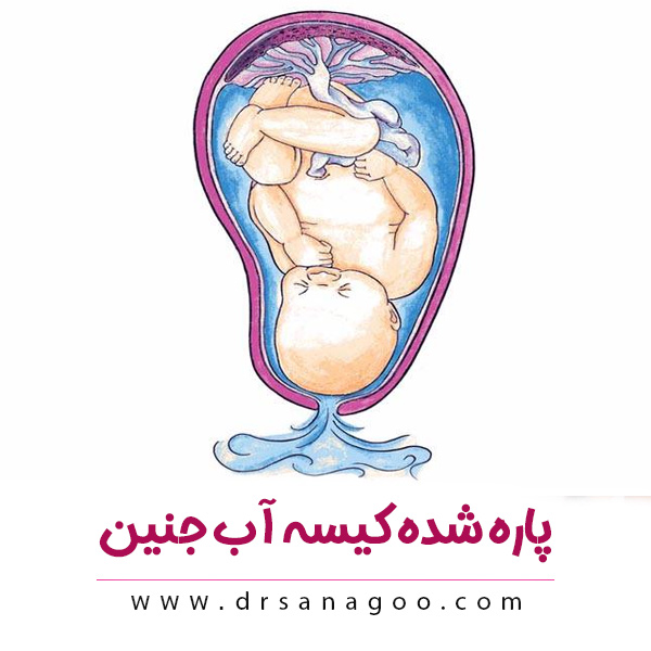 پاره شده کیسه آب جنین