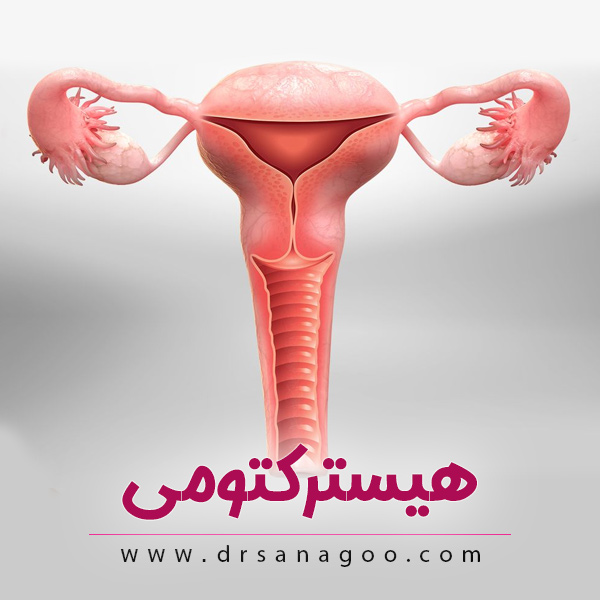 هیسترکتومی